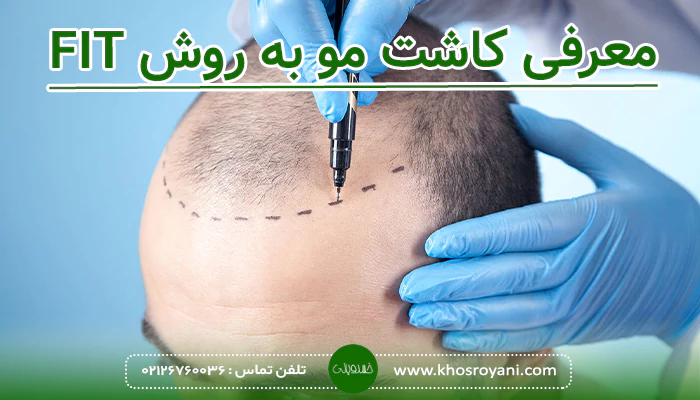 کاشت مو به روش FIT