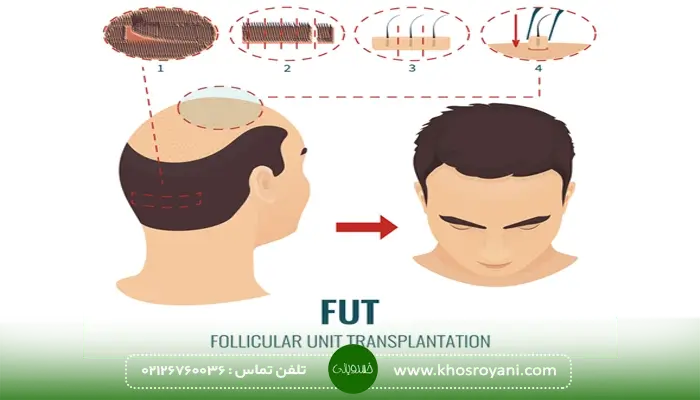 هزینه کاشت مو با روش FUT