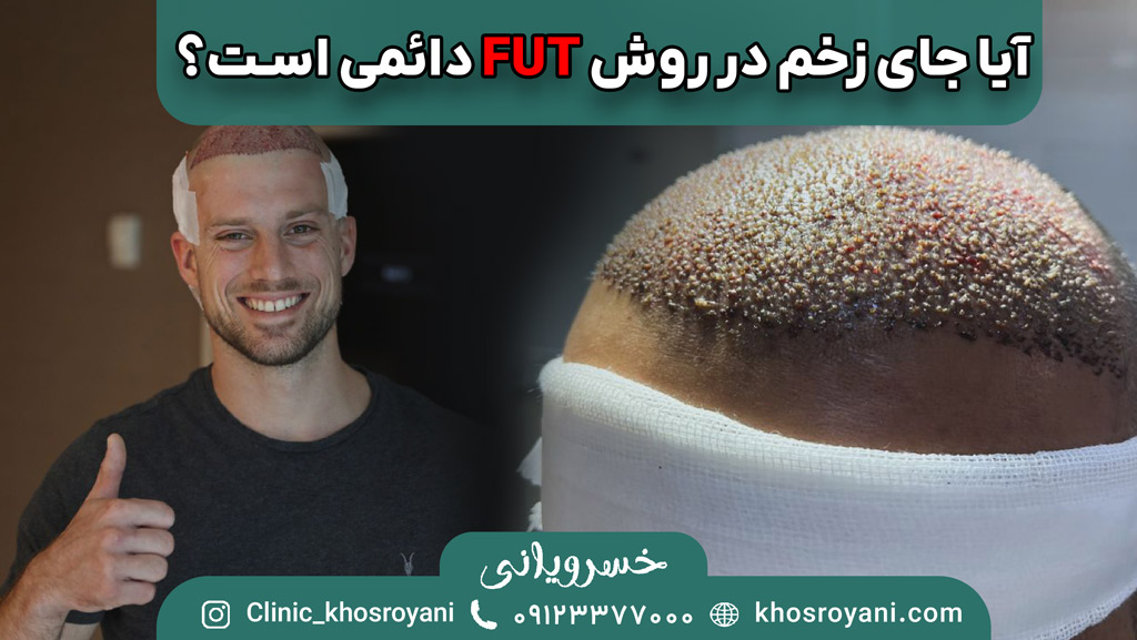 آیا جای زخم در روش FUT دائمی است؟