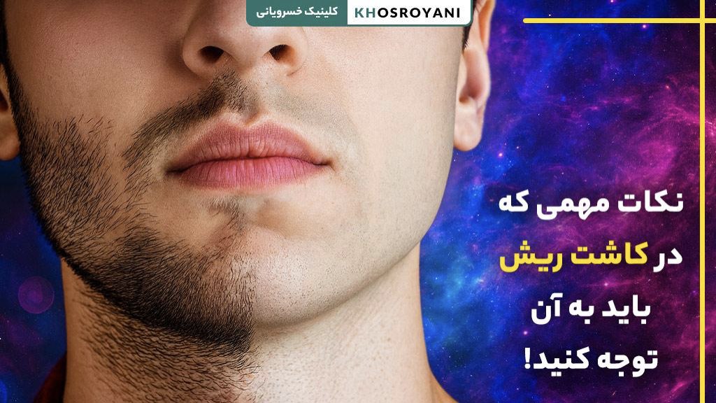 نکات مهمی که در کاشت ریش باید به آن توجه کنید!