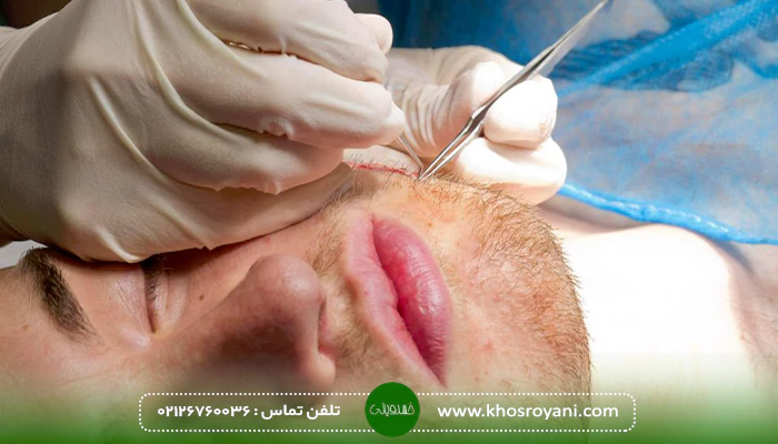 مراحل کاشت ریش