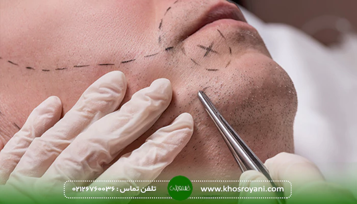 هزینه کاشت ریش