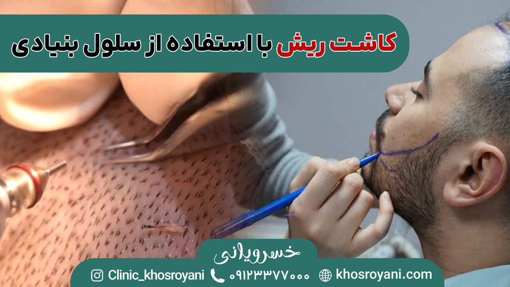 کاشت ریش با سلول بنیادی