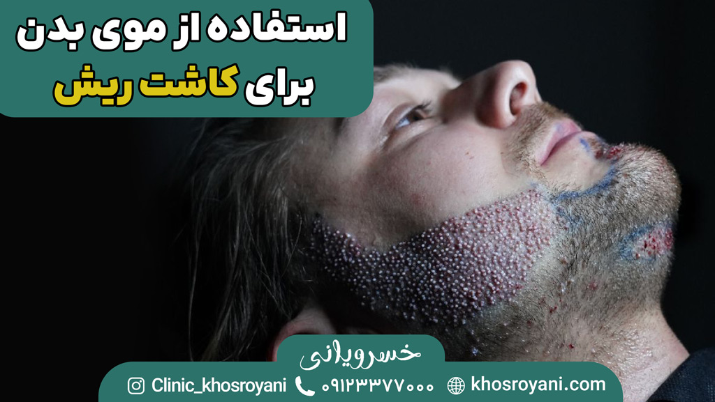 پیوند موی بدن به ریش