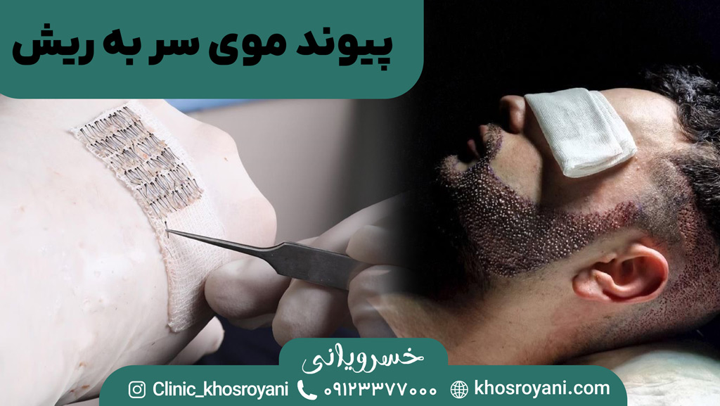 پیوند موی سر به ریش