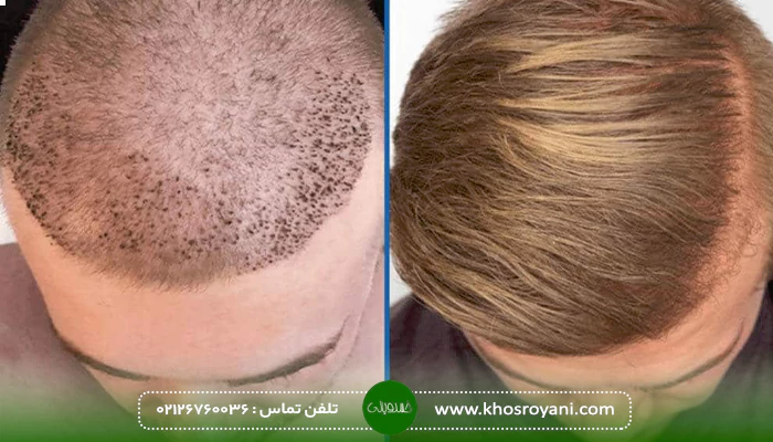 مزایای کاشت موی تضمینی