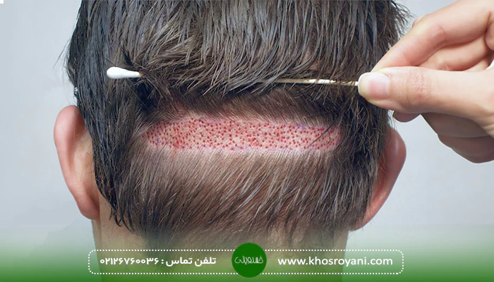 کاشت مو FUE