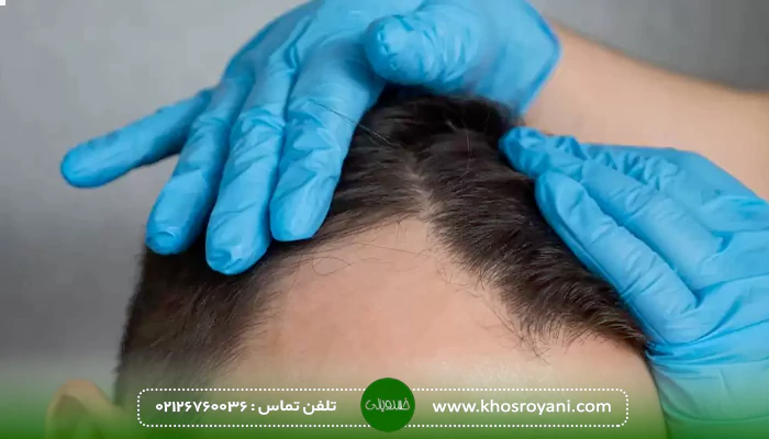 مقایسه روش های کاشت مو