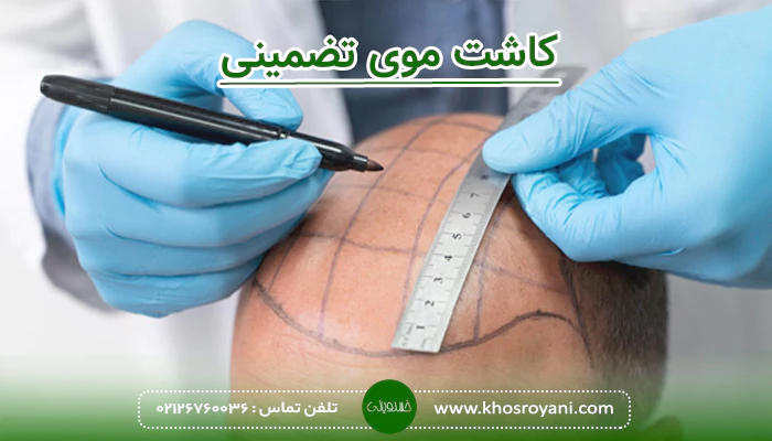 کاشت موی تضمینی