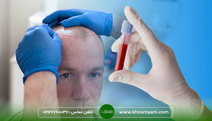 آزمایشات فشار خون قبل از کاشت مو