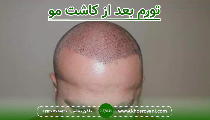 دلایل ایجاد تورم بعد از کاشت مو چیست؟
