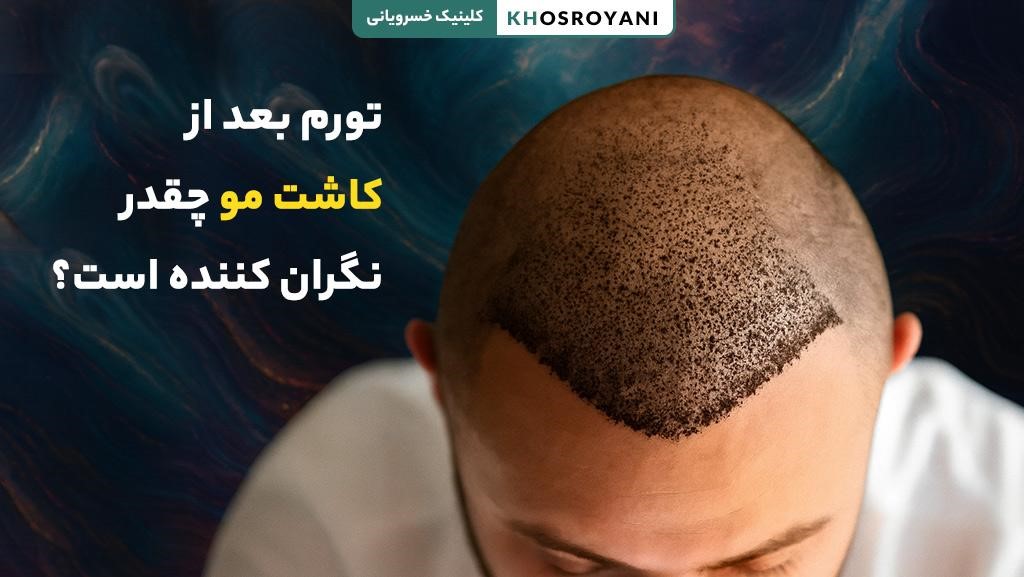 تورم بعد از کاشت مو چقدر نگران کننده است؟