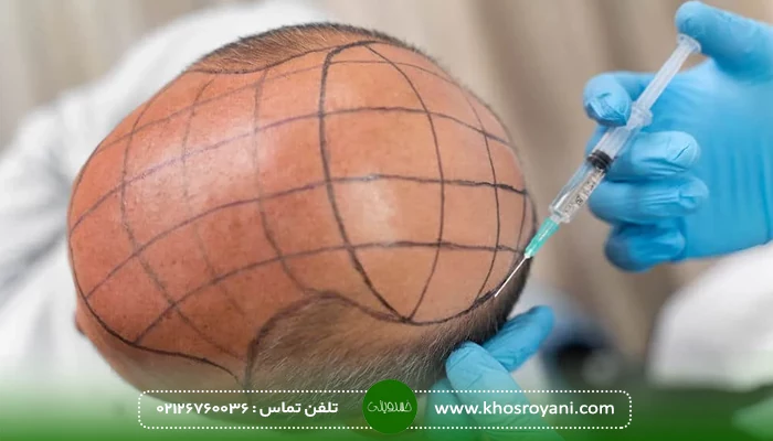 فعالیت و ورزش سنگین بعد از کاشت مو
