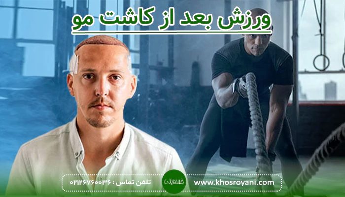 زمان شروع ورزش بعد از کاشت مو 