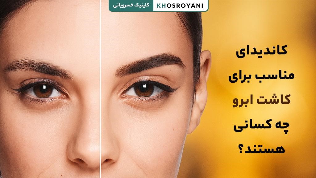 کاندیدای مناسب برای کاشت ابرو چه کسانی هستند؟