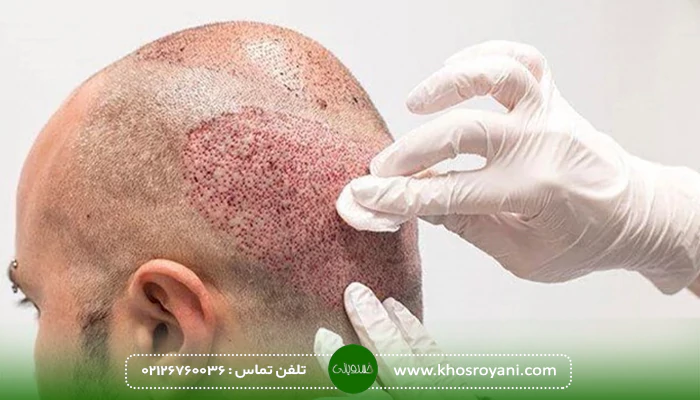 چه نوع ورزش هایی را بعد از کاشت مو می توان انجام داد؟