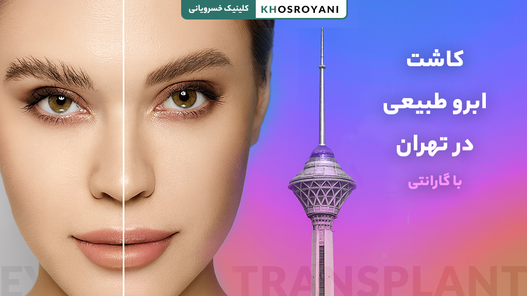 کاشت ابرو طبیعی در تهران