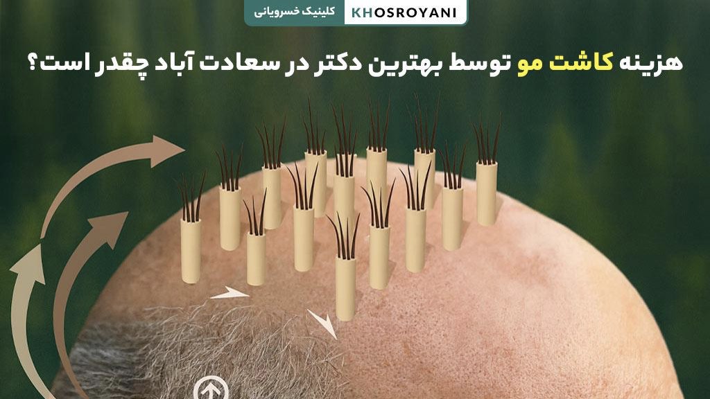 هزینه کاشت مو توسط بهترین دکتر در سعادت آباد چقدر است؟
