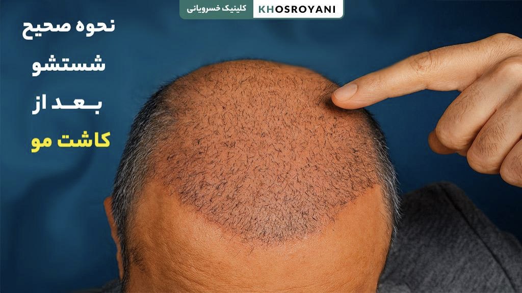 نحوه صحیح شستشو بعد از کاشت مو (به توصیه دکتر محمد خسرویانی)