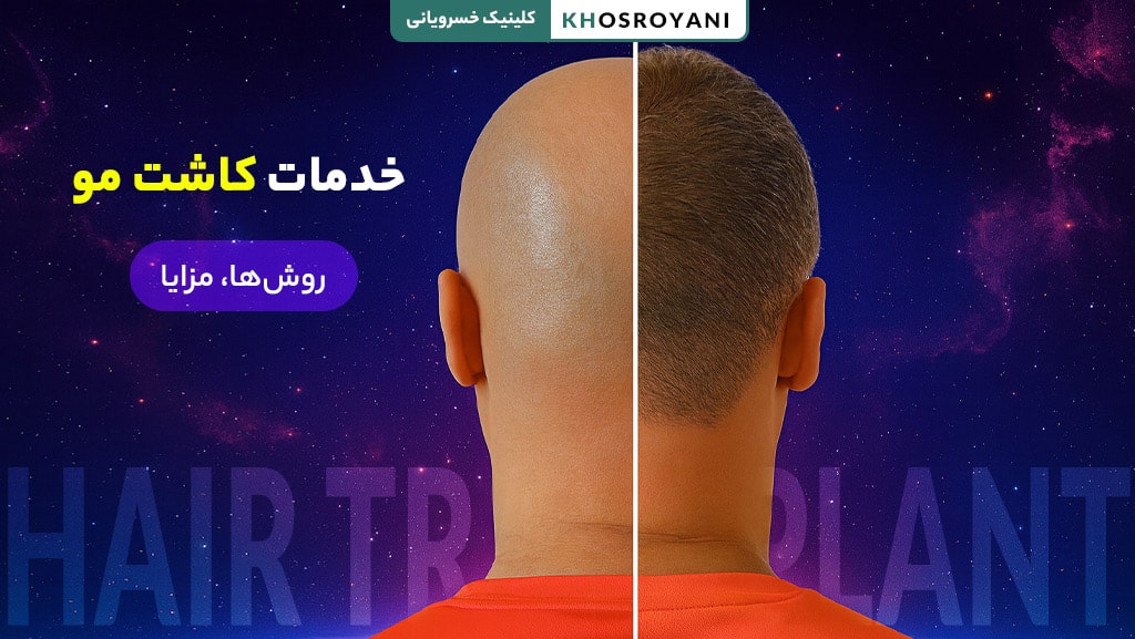 کاشت مو