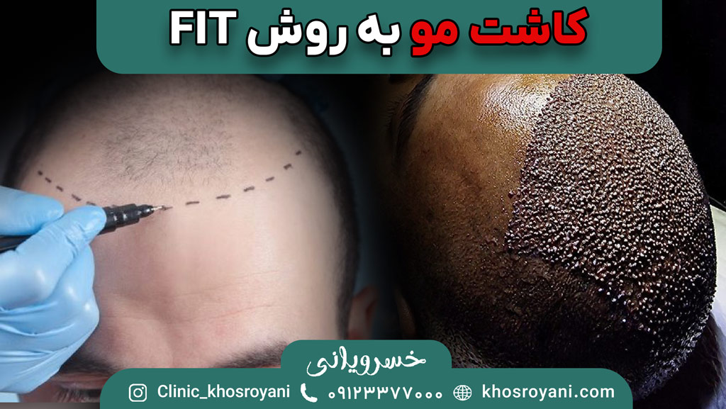 کاشت مو به روش FIT