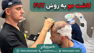 کاشت مو به روش FUT
