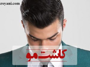 چرا کاشت مو