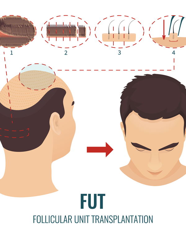 کاشت مو به روش FUT