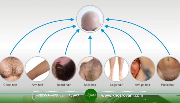 بانک مو برای کاشت BHT