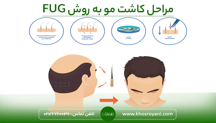 مراحل کاشت مو به روش FUG