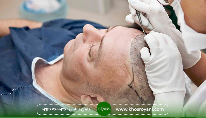 مزایای کاشت مو به روش BHT 