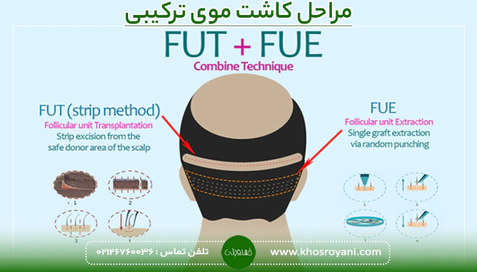 مراحل کاشت موی ترکیبی