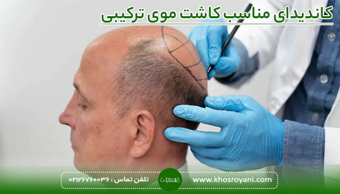 کاندیدای مناسب کاشت موی ترکیبی