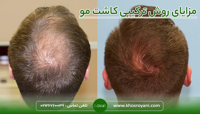 مزایای روش ترکیبی کاشت مو