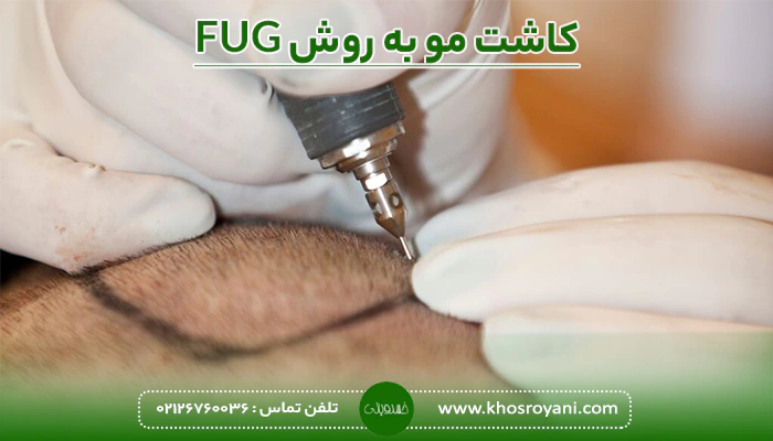 کاشت مو به روش FUG چگونه است؟