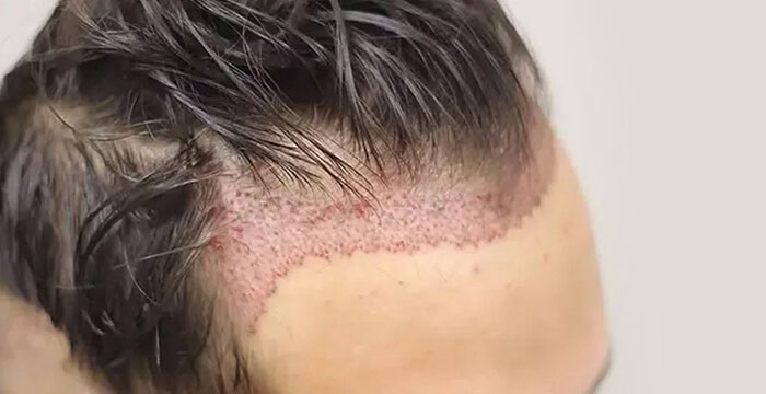 کاشت مو به روش sut