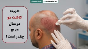 هزینه کاشت مو