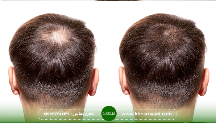 مزایای کاشت مو به روش SAFER