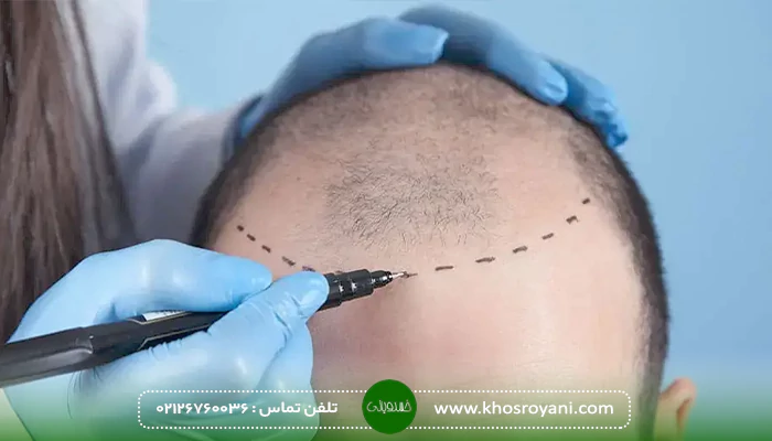 معایب کاشت مو به روش SAFER
