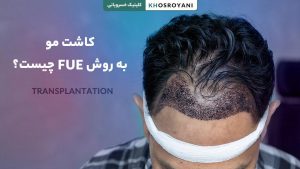 کاشت مو به روش FUE