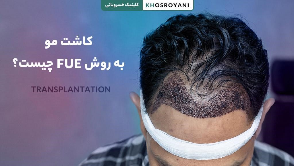 کاشت مو به روش FUE