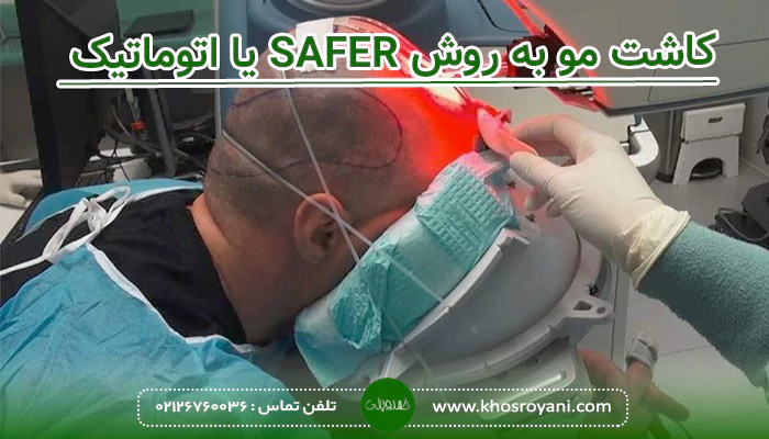 کاشت مو به روش SAFER یا اتوماتیک
