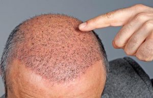 دلمه های بعد از کاشت مو