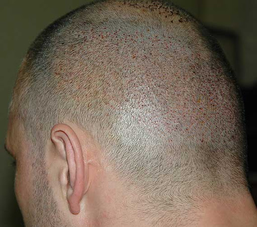 مراقبت بعد از کاشت مو به روش FIT