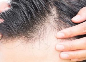 ریزش مو بعد از کاشت