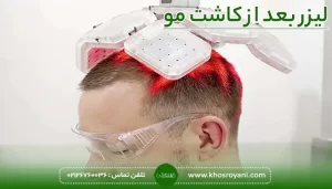 لیزر بعد از کاشت مو