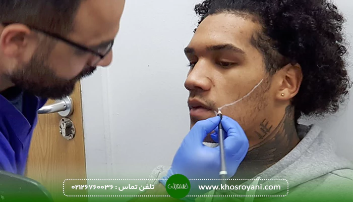 عوارض کاشت ریش و سبیل