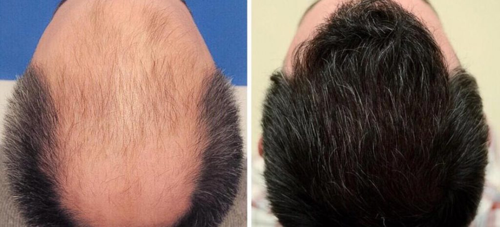 نمونه کارهای کلینیک کاشت مو دکتر خسرویانی