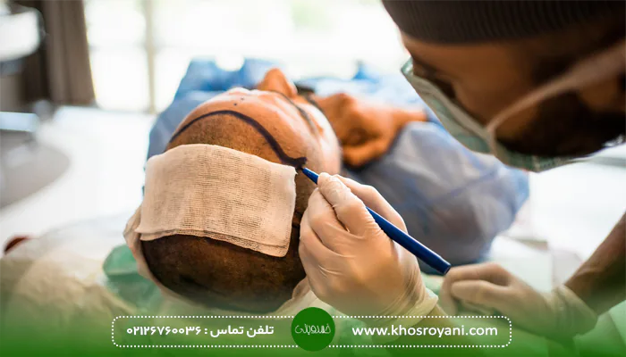تاثیر بانک مو در موفقیت کاشت مو