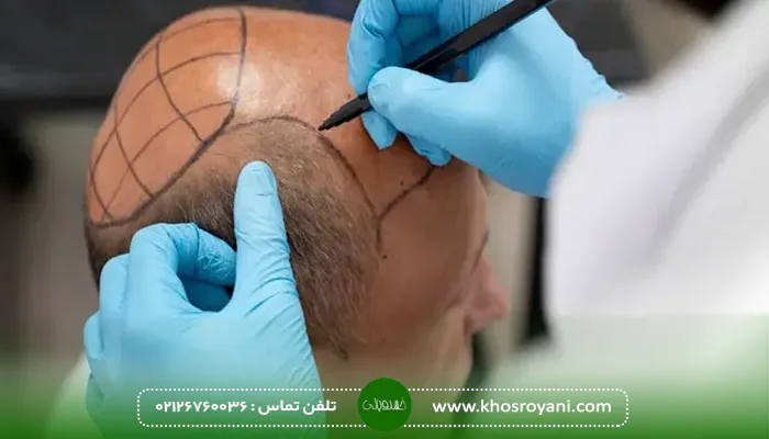 ترمیم مو به روش HRT